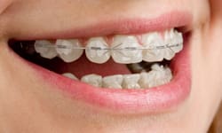 Clear (Ceramic) Braces