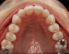 Top view of crooked teeth on patient - After treatment