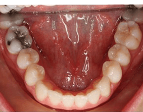 Bottom view of crooked teeth on patient - After treatment