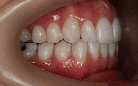 Side view of crooked teeth on patient - After treatment