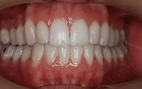 Front view of crooked teeth on patient - After treatment