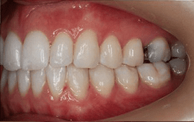 Side view of crooked teeth on patient - After treatment