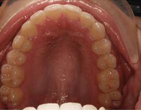 Top view of crooked on patient - After treatment