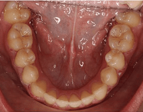 Bottom view of crooked on patient - After treatment