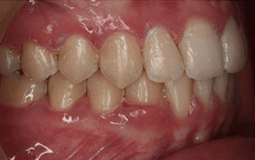 Side view of crooked teeth on patient - After treatment