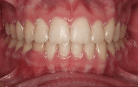 Front view of crooked teeth on patient - After treatment