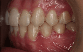 Side view of crooked teeth on patient - After treatment