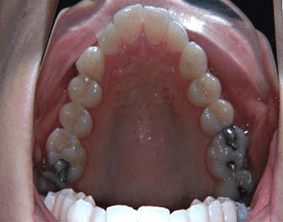 Top view of crooked teeth on patient - Before treatment