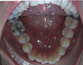 Bottom view of crooked teeth on patient - Before treatment