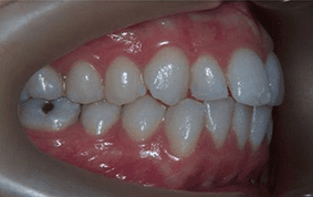 Side view of crooked teeth on patient - Before treatment