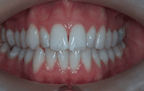 Front view of crooked teeth on patient - Before treatment