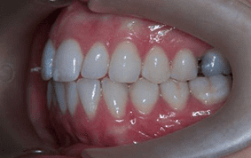 Side view of crooked teeth on patient - Before treatment