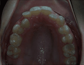 Top view of crooked teeth on patient - Before treatment