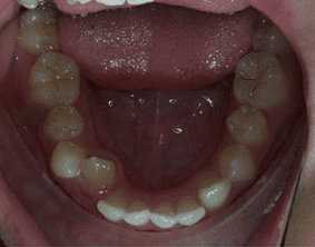 Bottom view of crooked teeth on patient - Before treatment