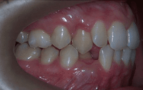 Side view of crooked teeth on patient - Before treatment