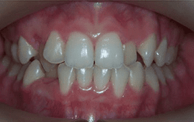 Front view of crooked teeth on patient - Before treatment