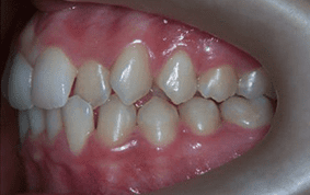 Side view of crooked teeth on patient - Before treatment