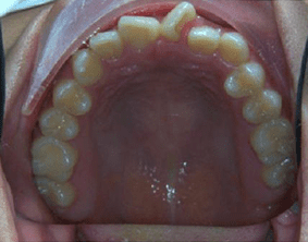 Top view of crooked teeth on patient - Before treatment