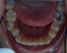 Bottom view of crooked teeth on patient - Before treatment