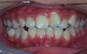 Front view of crooked teeth on patient - Before treatment