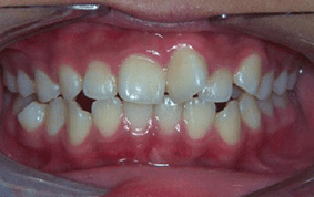 Front view of crooked teeth on patient - Before treatment