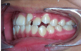 Side view of crooked teeth on patient - Before treatment