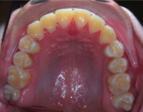 Top view of underbite on patient - After treatment