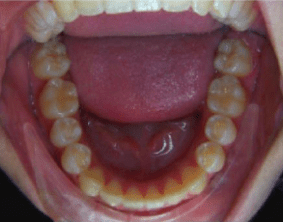 Bottom view of underbite on patient - After treatment