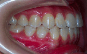 Side view of underbite on patient - After treatment