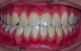 Front view of underbite on patient - After treatment