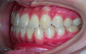 Side view of underbite on patient - After treatment