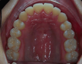 Top view of underbite on patient - Before treatment