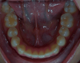 Bottom view of underbite on patient - After treatment