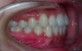 Side view of crossbite on patient - After treatment