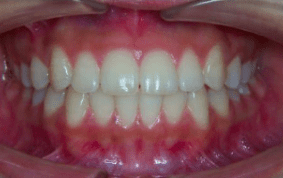 Front view of underbite on patient - After treatment