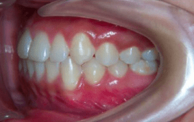 Side view of underbite on patient - After treatment