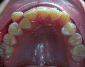 Top view of underbite on patient - Before treatment