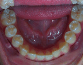 Bottom view of underbite on patient - Before treatment