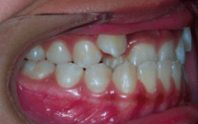 Side view of underbite on patient - Before treatment