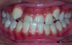 Front view of underbite on patient - Before treatment