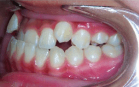 Side view of underbite on patient - Before treatment