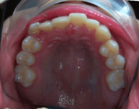 Top view of underbite on patient - Before treatment