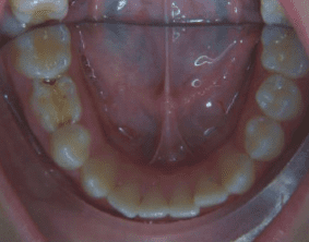 Bottom view of underbite on patient - Before treatment