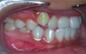 Side view of underbite on patient - Before treatment