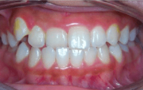 Front view of underbite on patient - Before treatment