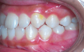 Side view of underbite on patient - Before treatment