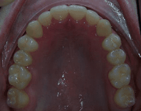 Top view of impacted teeth on patient - After treatment