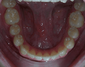 Bottom view of impacted teeth on patient - After treatment