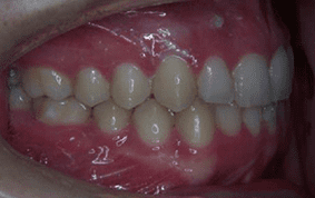 Side view of impacted teeth on patient - After treatment