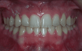 Front view of impacted teeth on patient - After treatment